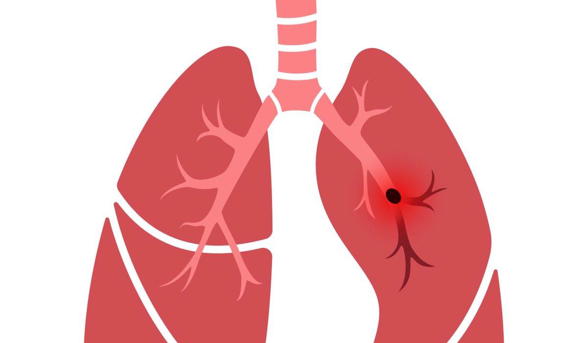 Pulmonary embolism disease. Deep vein thrombosis. Blood clot in lung vein anatomical poster